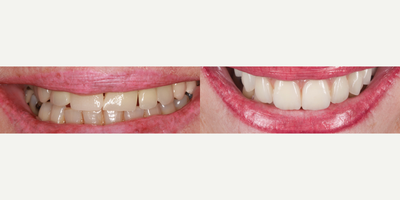 45-54 year old woman treated with ClearChoice Dental Implants - Patient with multiple crowns and misplaced implants treated with dental implants to improve her smile.