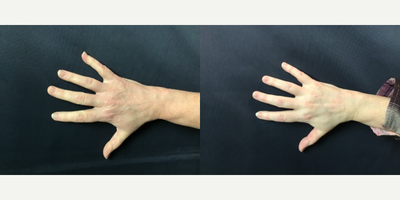 35-44 year old woman treated with Pelleve - Hand treatment before 1st treatment and after 3rd treatment