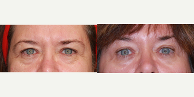 45-54 year old woman treated with CO2 Laser - My patient wanted help with her acne scarring and her tired eyes. She was not ready for eyelid surgery so we opted for 2 sessions of CO2 laser resurfacing for both her acne scarring and her eye area. She has never worn her hair down,  because she was always self conscious about her scarring so now she feels her skin has improved enough to wear her hair up. Her skin appears softer, smoother and her eyes appear refreshed without surgery.