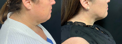 45-54 year old woman treated with Smart Lipo - Submental liposuction