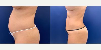 35-44 year old woman treated with Liposuction, Tummy Tuck - Limited TT and Lipo