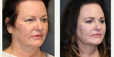 Enigmalift and fat transfer. - Enigmalift Browlift and eyelid lift with fat transfer and non-surgical neck tightening and lip lift.