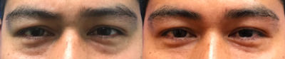 25-34 year old woman treated with Restylane - Restylane injection under the eyes to treat eye bags on this young man.