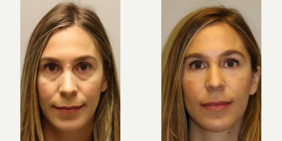Woman treated with Restylane - Woman treated with Restylane as fillers for her eye bags and hollows around the eyes which give impression of aging and fatigue.Patient is shown before and immediately after treatment.