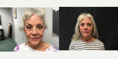 65-74 year old woman treated with Injectable Fillers - immediately after fillers and after a series of 3 Aquagold treatments with PRP