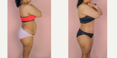 25-34 year old woman treated with Tummy Tuck, Liposuction - This patient wanted to improve the appearance of her abdomen after having children. She wanted to improve her core strength so she could get back to the activities she loved. She underwent a Tummy tuck and Liposuction and is shown 3 months after surgery.