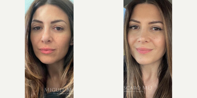 Woman treated with Rhinoplasty - Woman treated with Rhinoplasty and Eyelid Surgery through upper blepharoplasty