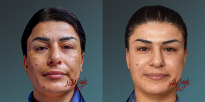 35-44 year old woman treated with PicoSure - 35-44 year old woman treated with PicoSure