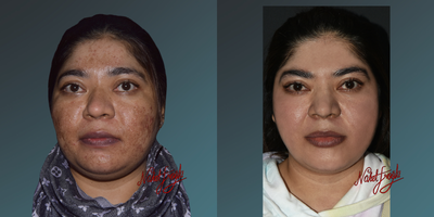 35-44 year old woman treated with Fraxel Laser - 35-44 year old woman treated with Fraxel Laser