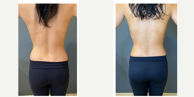 25-34 year old woman treated with Breast Augmentation, Breast Fat Transfer, Natrelle Breast Implants - 29 year old woman shown 7 months after undergoing breast augmentation with 300cc moderate projection saline implants. She also underwent cleavage fat grafting for more feminine, natural results.  The long lasting fat was harvested from her flank (love handle) region which also helped create a more slim waist!Height - 5'5        weight- 125 lbs.       Bra: 36B. >> 34C cup