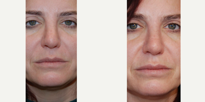 45-54 year old woman treated with Silikon 1000, Lip Surgery - Our 48 year old patient is seen nearly a month after permanent lip augmentation with microdroplet Silikon-1000. You can see smooth, natural looking lips that are just perfect for her - without any stigmata of being done. Unlike temporary gel fillers, Silikon-1000 never leads to necrosis, infection, blindness, embolism or stroke. This is because the size of a Silikon-1000 molecule is smaller than a red blood cell. Unlike HA which is a gel, and a large molecule that can cause vascular occlusion, embolism, and other problems.She has persistent nodularity over her nasolabial folds from previous HA filler. As that dissipates, we will proceed with a nasolabial treatment in around two months. Stay tuned!