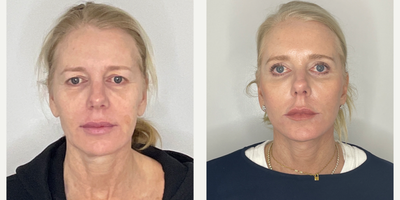 55-64 year old woman treated with Facelift, Neck Lift, Eyelid Surgery, Facial Fat Transfer, Laser Resurfacing, CO2 Laser - 55 year old 3 months after Facelift, Neck Lift, Eyelid Surgery, Facial Fat Transfer, CO2 Laser Resurfacing