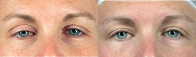 Ptosis repair - Before and after ptosis repair of both upper eyelids.