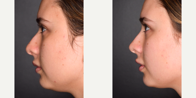 Woman treated with Nonsurgical Nose Job - Before and after of nose filler