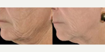 Woman treated with Infini RF - Woman treated with Infini RF