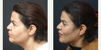 45-54 year old woman treated with Facelift - Facelift Surgery - 12 months post-op