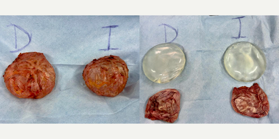 55-64 year old woman treated with Capsular Contracture Treatment, Breast Implant Removal - Famale patient with breast implant illnes (BII)  and Asia syndrome, she had an Enbloc capsulectomy with infamammary approach.