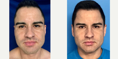 35-44 year old man treated with Buccal Fat Removal - Buccal Fat Removal