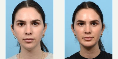 25-34 year old woman treated with Chin Implant - This 32-year-old patient came to Dr. Wise with concerns about her small, recessed chin, which affected the balance of her profile. By performing a chin augmentation, Dr. Wise enhanced her chin projection, creating a more harmonious and proportionate look. The result is a balanced profile that complements her facial features beautifully.