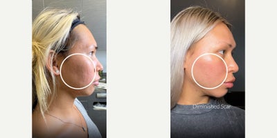 25-34 year old woman treated with Subcision, Bellafill, Halo Laser, CO2 Laser - My patient was over her acne scars! And she knew I was the provider to help her achieve her dream skin. Finally getting rid of those deep acne scars that had been holding her back for years was a total game changer for her confidence! Shed really tried everything  but nothing was getting the job done. Thats where a custom, combination approach changed the game for her skin.With her sensitive skin in mind, I crafted a high-impact plan that didnt cut any corners. From prepping her skin with a chemical peel to a meticulously chosen lineup of lasers and filler, every step was designed for serious results. She followed up with all of the Emer Skin products, healing fast to show off her insane transformation!Heres the combo that made it happen: Subcision Bellafill Halo  CO2 Spot Treatment PRPThis is what happens when you go beyond the basics and are committed to getting the BEST possible outcome. What do you think of her transformation?