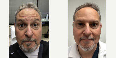 55-64 year old man treated with Daxxify - Dr. Berkowitz was treated with Daxxify to treated fine lines and wrinkles