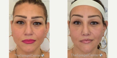 35-44 year old transgender woman treated with Transgender Facial Feminization Surgery - 35-44 year old transgender woman treated with Transgender Facial Feminization Surgery