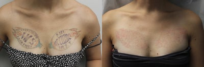 Patient with two large, chest tattoos after five PicoSure treatment's  - Patient came to me after 7 Q-switch ND Yag treatments, she felt she had plateaued. These photos show the progress after 5 PicoSure treatments.