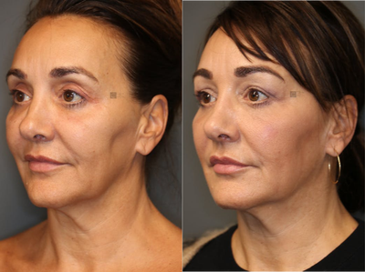 Pan Facial Rejuvenation - Upper and lower lid filler, temple and jawline rejuvenation.