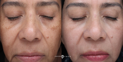35-44 year old woman treated with Cosmelan - This is a woman in her 40s, three weeks post op after Cosmelan and Clear+Brilliant Laser.