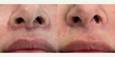 35-44 year old woman treated with ProFractional Laser - ProFractional Laser done on lip lift scar performed by 8 West Clinic, Vancouver, BC