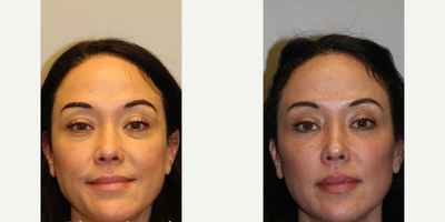 Woman treated with Facial Fat Transfer - This beautiful patient came in complaining that her lower eyes looked tired and she felt she had bags under her eyes. eyebags are often a hereditary trait and can be seen in patients as young as 20s and 30s. This patient was looking for a long term more permanent solution that doesnt require ongoing treatments. She opted for a lower blepharoplasty with fat transfer and laser resurfacing. When this procedure is performed at a young age often it can be done without any skin incisions on the face. The fat transfer allows subtle contouring to the cheek, face and tear trough to avoid hollowing.