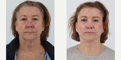 65-74 year old woman treated with Facelift, Neck Lift, Brow Lift, Eyelid Surgery, Lip Lift, CO2 Laser - 69 year old 2 months after facelift, neck lift, brow lift, upper and lower blepharoplasty, lip lift, co2 laser.
