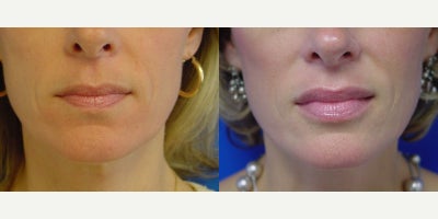 55-64 year old woman treated with Juvederm - This patient had 1/2 of a syringe of Juvederm to her lips. Our P.A., Julia sees patients every Wednesday and the 1st and 3rd Thursday of every month. She would be happy to have you as a patient for Botox and/or Juvederm and Restylane!