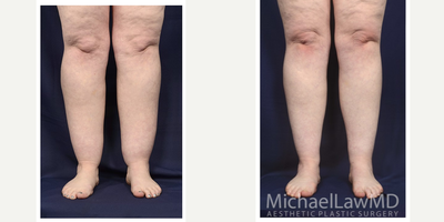 35-44 year old woman treated with Calf Reduction - Lower leg liposuction. Follow-up photo taken 6 months after the procedure.