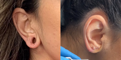 Woman treated with Earlobe Repair - Ear lobe repair process.