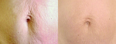 35-44 year old woman treated with Vivace - Vivace before and after