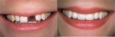 Dental Implant For Missing Front Tooth - 
	PT had failed root canal treatment in her upper left central incisor. The tooth was extracted and had an immediate dental implant and bone graft placed with a temporay crown, then 3 months later had her permanent crown placed with perfect results
