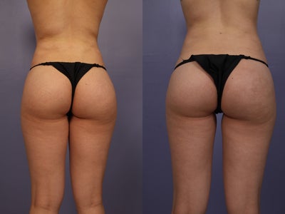 Revision Brazilian Butt Lift - Early 20s female, underwent liposuction and fat transfer to buttocks (Brazilian butt lift) by another surgeon previously.  Patient came to me for a revision because she noted significant contour irregularities to the love handle area from the previous liposuction and an asymmetry of the buttocks with more upper fullness of on her left buttocks than on her right.  I performed liposuction to her arms, back, love handles, inner thighs and fat transfer to right buttocks for symmetry.