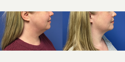 35-44 year old woman treated with Liposuction - Liposuction of the neck.