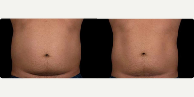 Woman treated with truFlex - Woman treated with Secret RF.