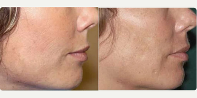 Woman treated with Secret RF - Woman treated with Secret RF.