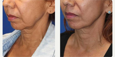 Woman treated with Secret RF - Woman treated with Secret RF.