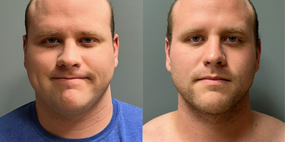 25-34 year old man treated with Neck Lift, Liposuction, Renuvion - Patient is 2 months following neck lift with lip and renuvion