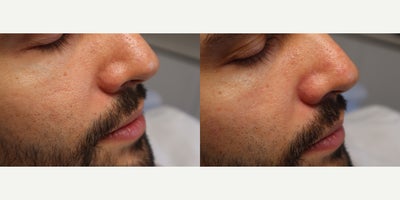 35-44 year old man treated with Stellar M22 - Nose telangiectasias erased with IPL spot and vascular filter