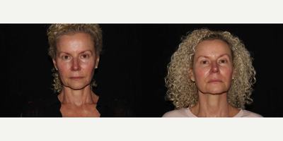 55-64 year old woman treated with Sofwave - Full Face and Neck Sofwave, 3 Month Follow Up Photos