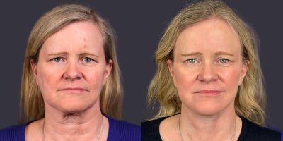 55-64 year old woman treated with ActiveFX, Brow Lift, Facelift, Laser Resurfacing, Lower Facelift, Neck Lift, SMAS Facelift - 56 year old who presented for facial rejuvenation. She is 5'5 and 158 pounds. She had a brow lift, lower face and neck lift, as well as central face CO2 laser skin resurfacing.