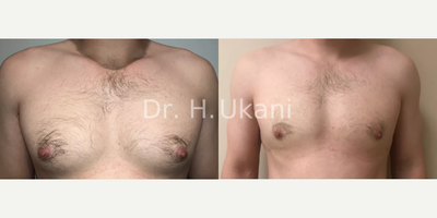 Man treated with Gynecomastia Surgery - This patient had VASER Liposuction treatment to the chest with additional direct excision. The VASER liposuction helps with skin retraction and helps to keep the overlying skin tight.