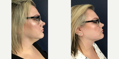 Woman treated with Microneedling RF - One Agnes RF Treatment, Immediately after