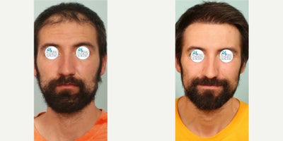 35-44 year old man treated with Hair Transplant - 8 months post hair transplant.