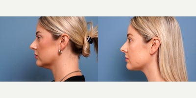 36 year old woman treated with MyEllevate - 36 year old woman treated with MyEllevate with 15 cc liposuction to neck. Photos depict before and 6 weeks after surgery.